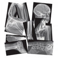 Broken bones X-ray collage with multiple grayscale bone scans, assorted views