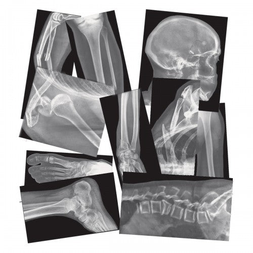 Broken bones X-ray collage with multiple grayscale bone scans, assorted views